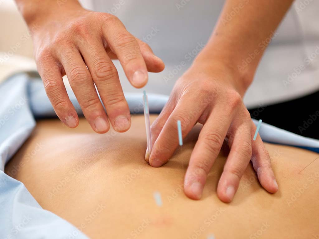 Needles of Serenity: Unraveling the Hidden Benefits of Acupuncture for Sunrise Residents